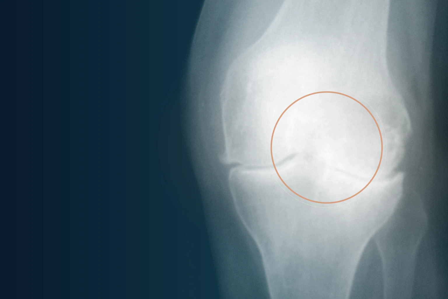Knieklachten en artrose: waarom bewegen beter is dan rust